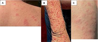 Immune checkpoint inhibitor-induced subacute cutaneous lupus erythematosus: a case report and review of the literature